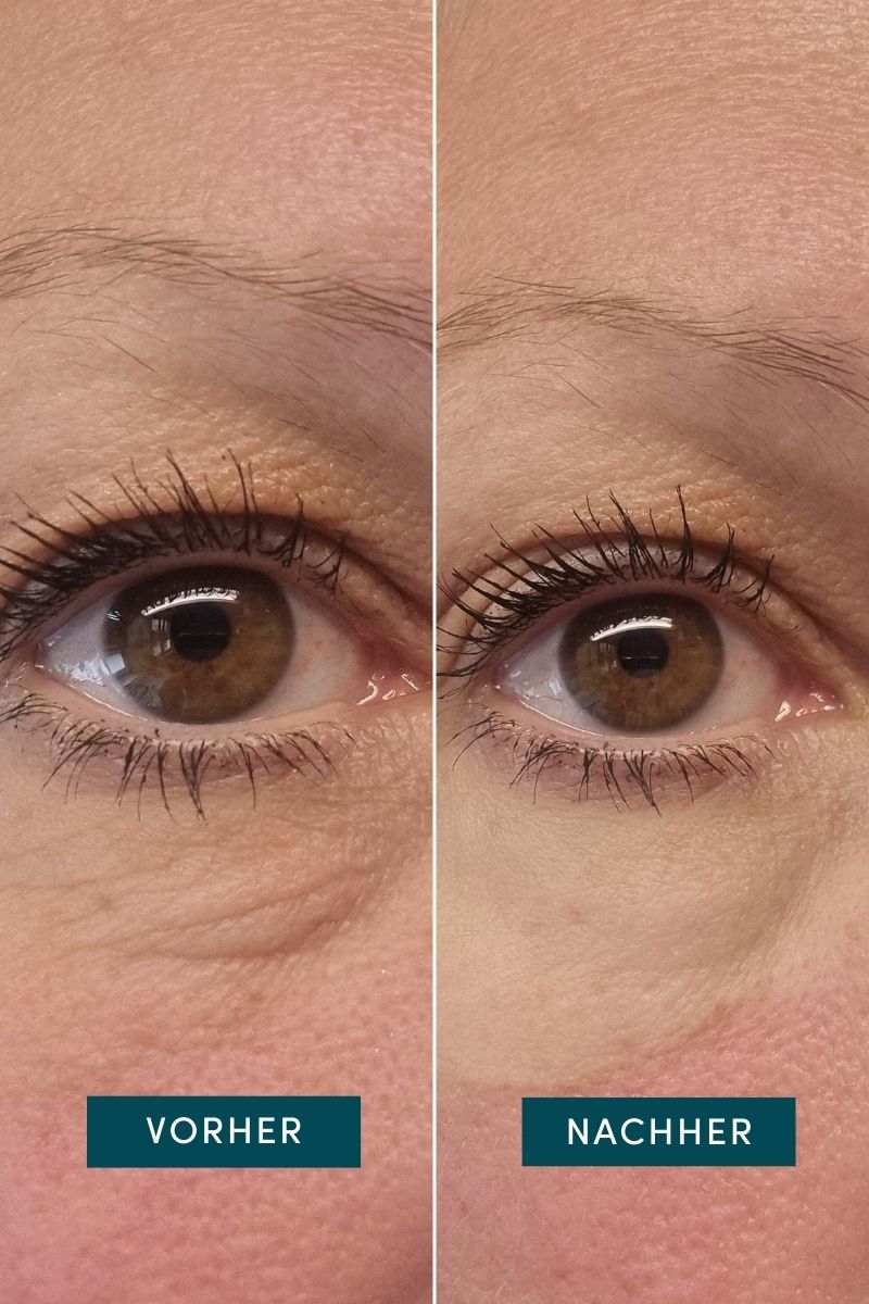 Augen-Schläfen Pads mit Hexapeptid-8