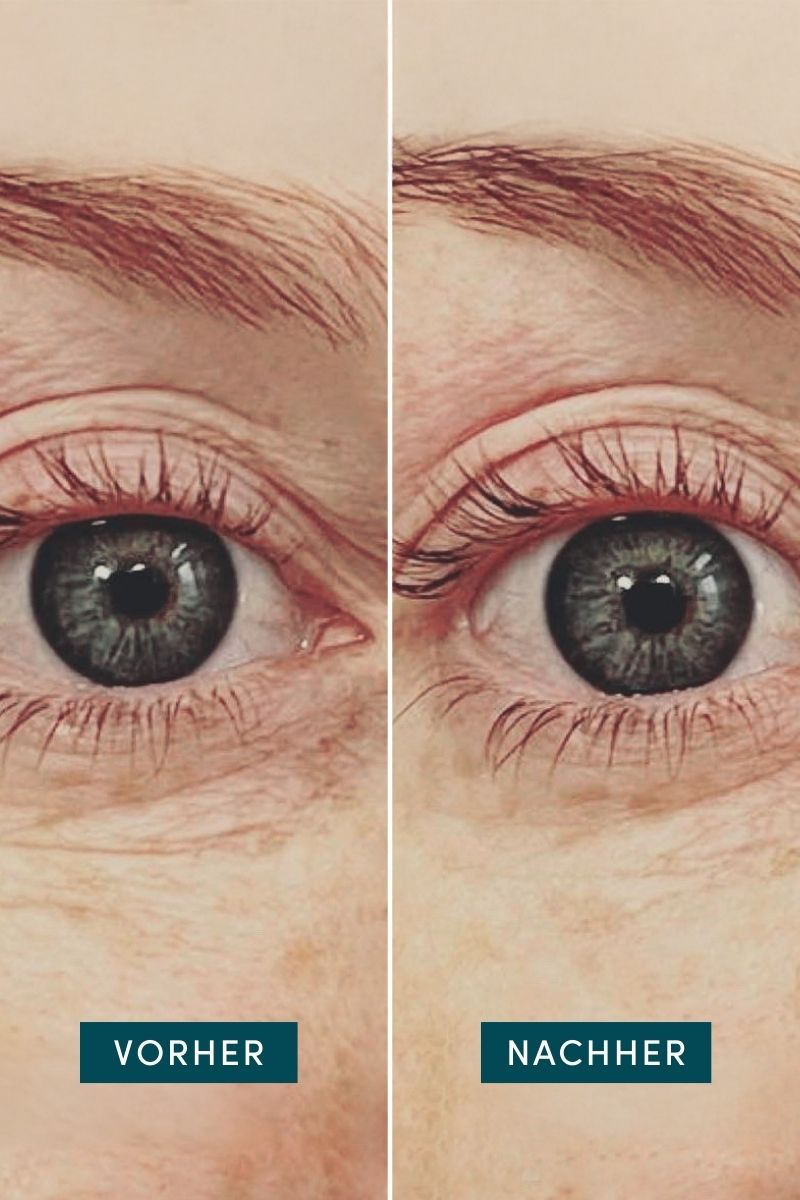 Augen-Schläfen Pads mit Hyaluron