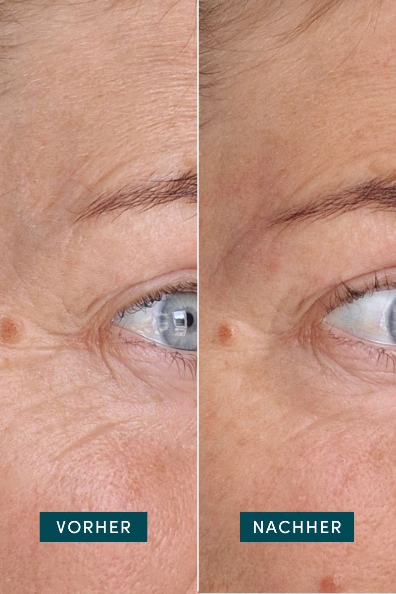 Augen-Schläfen Pads mit Ectoin