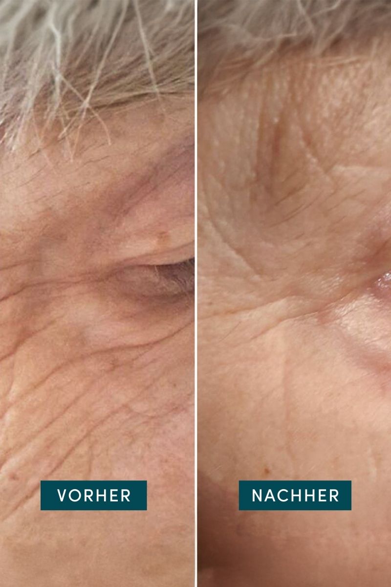 Augen-Schläfen Pads mit Hyaluron