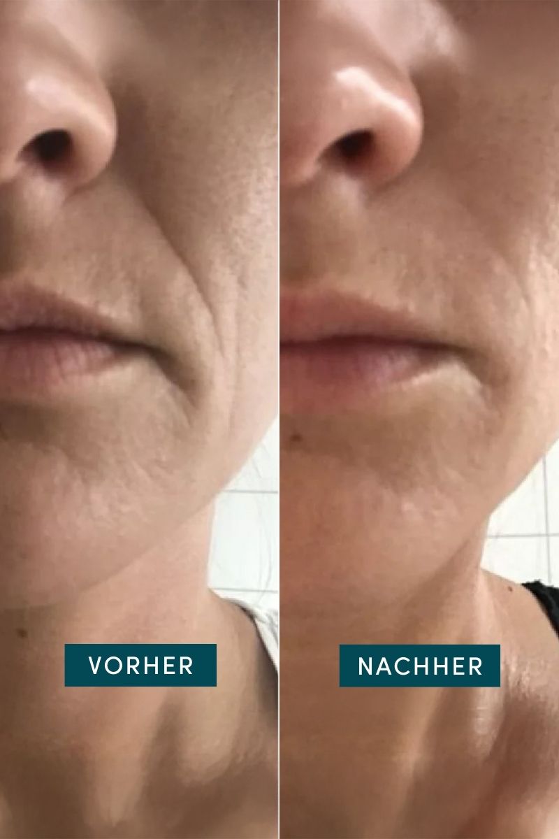 Mund Patches mit Hyaluron